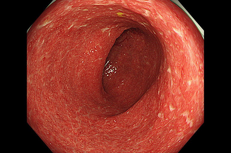 潰瘍性大腸炎